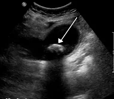 A 1.9&nbsp;cm gallstone impacted in the neck of the gallbladder and leading to cholecystitis as seen on ultrasound. There is 4&nbsp;mm gall bladder wall thickening.