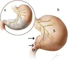 Illustration of Antrectomy