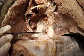 Front photo of the Ductus Thoracicus in the Human mediastinum with the heart and part of the pericard removed.