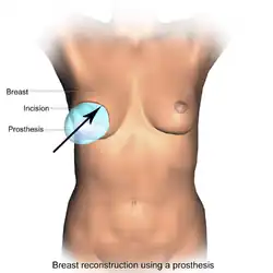 Breast reconstruction using a prosthesis.